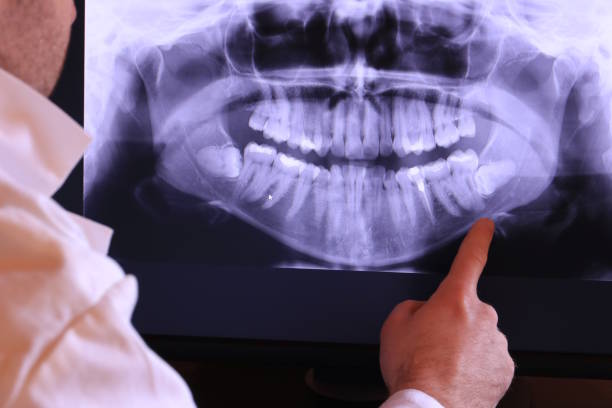 Best Emergency Wisdom Tooth Extraction in Omaha, NE